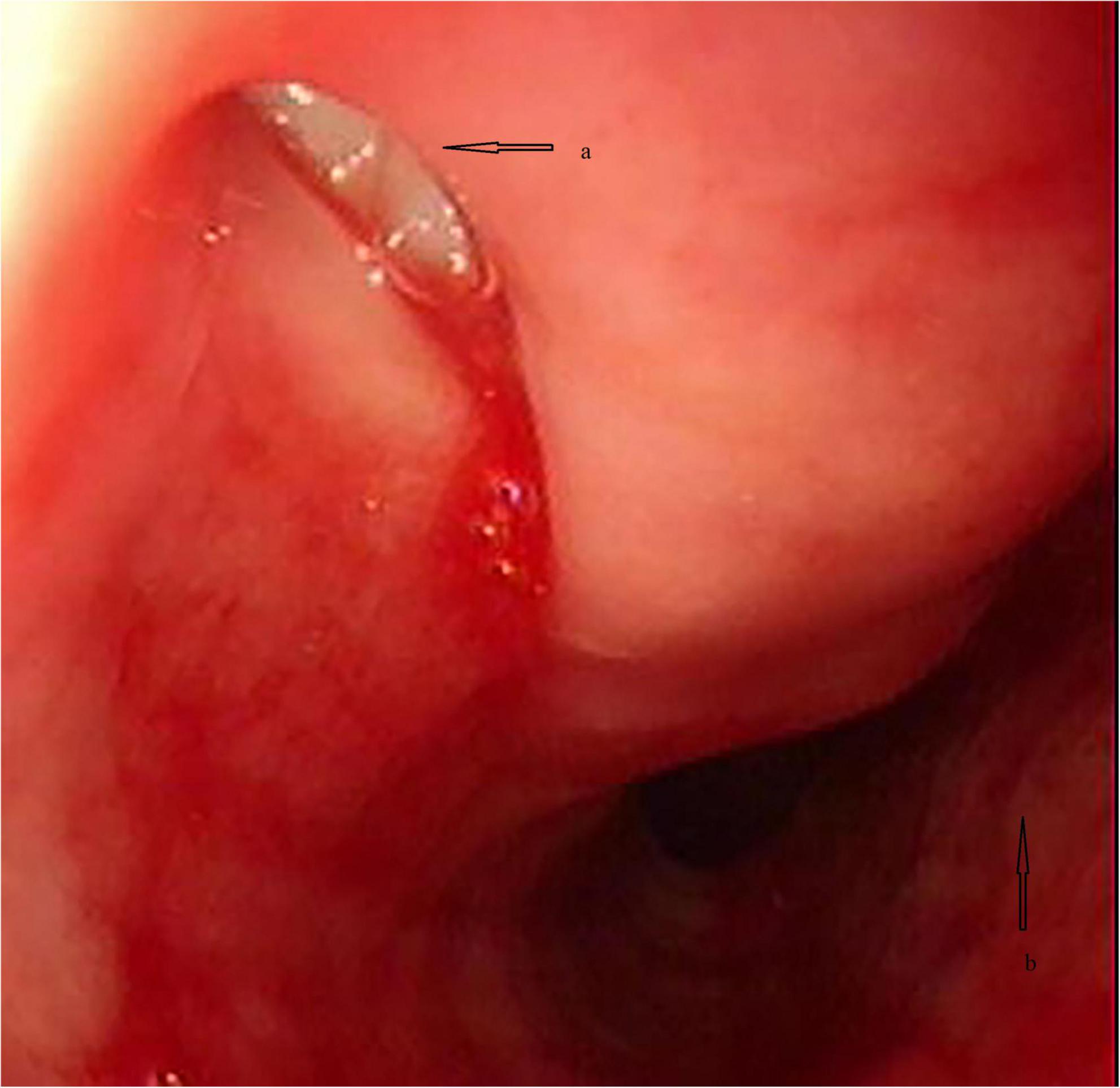 Supraglottic jet oxygenation and ventilation via nasopharyngeal airway for a patient with iatrogenic tracheoesophageal fistula: A case report